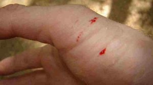 snake-bite